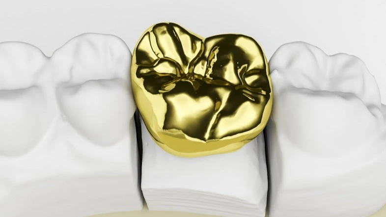 Goldkrone auf präpariertem Zahn – Fortbildung zahntechnische Abrechnung für Fortgeschrittene | Spitta Akademie