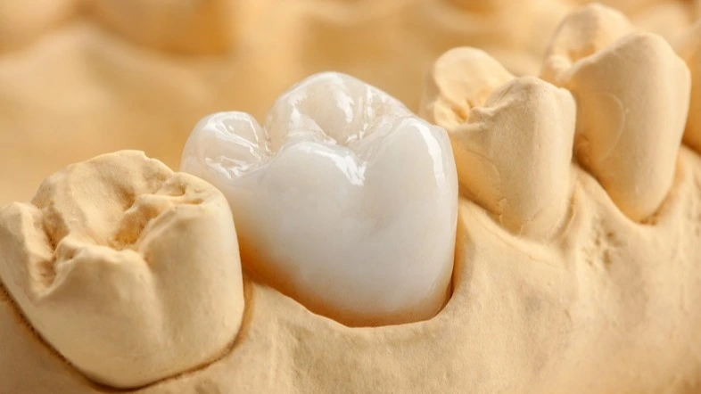 Keramikkrone auf Gipsmodell im Dentallabor – Power-Workshop zahntechnische Abrechnung für Einsteiger | Spitta Akademie