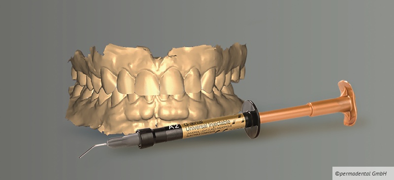 F.I.T. – Die smarte Composite-Lösung mit innovativer Injektionstechnik F.I.T. – Die smarte Composite-Lösung mit innovativer Injektionstechnik