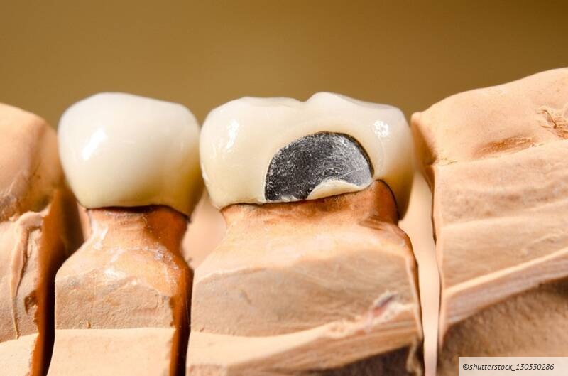 Abrechnung von zahntechnischen Leistungen bei Reparaturen